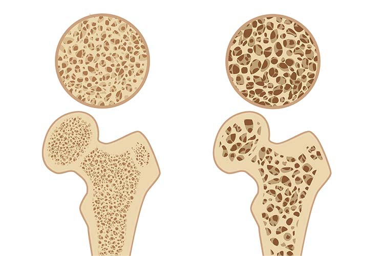 骨粗しょう症のイメージ画像